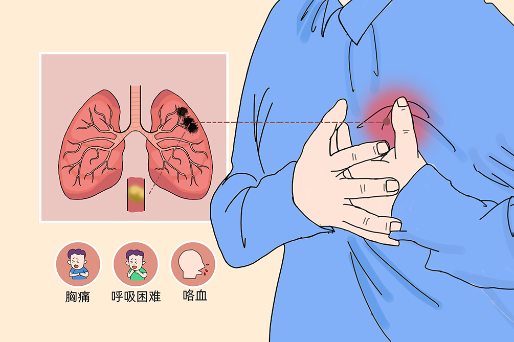 VTE的危害您了解吗？